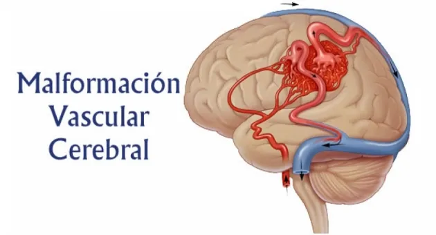 Malformación Vascular Cerebral